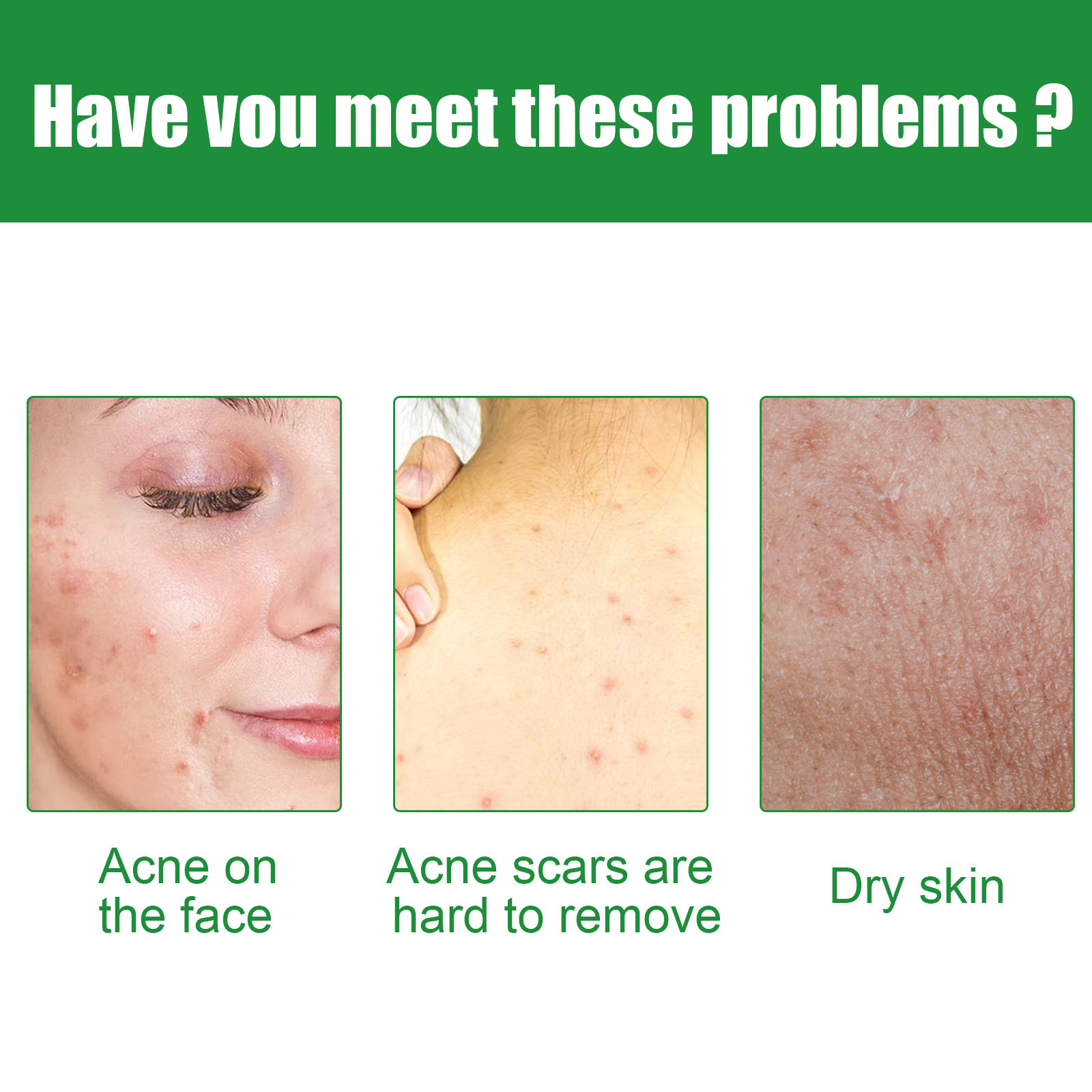 The Effectiveness of Hot毛巾敷脸痘痘会好吗 on Acne: A Detailed Analysis
