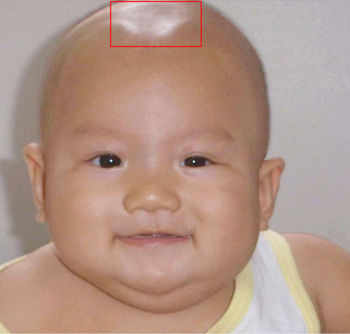 The Role of Hot毛巾敷囟门 in Traditional Chinese Medicine